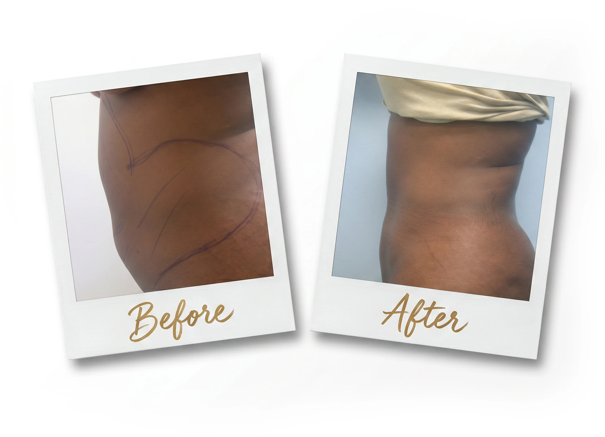 Before and After images of Liposuction