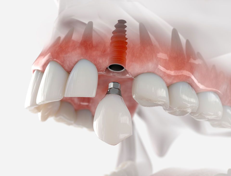Implant-supported crown