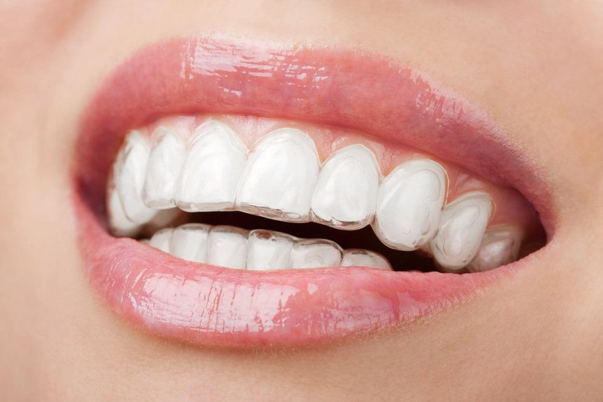 Invisalign tray on teeth