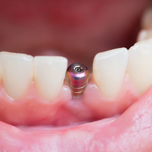 Close-up of implant in the gumline