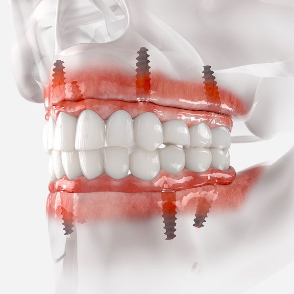 Illustration of implant-supported denture in the jaw