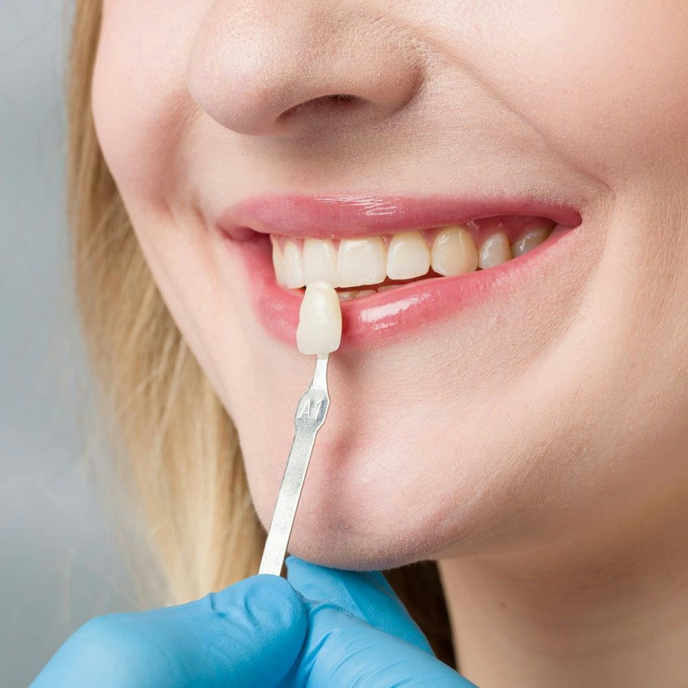 Veneers being shade-matched to tooth