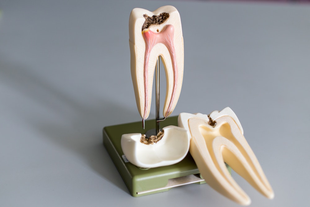 Model of a decayed tooth and its pulp chamber