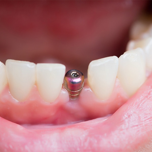 Dental Implant