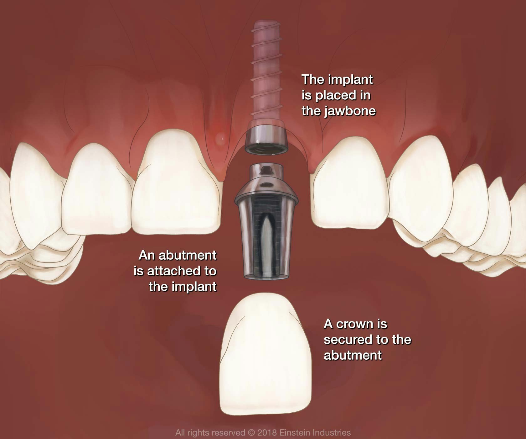 The implant is placed in the jawbone. An abutment is attached to the implant. A crown is secured to the abutment.