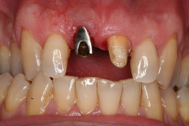 smile with missing teeth