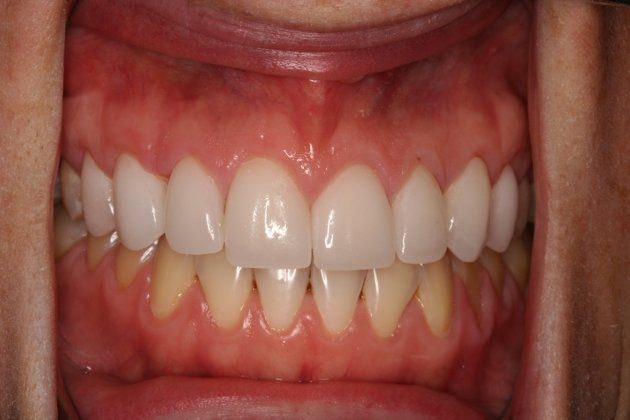 Malki Dental patient after porcelain veneers