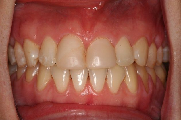Malki Dental patient before porcelain veneers