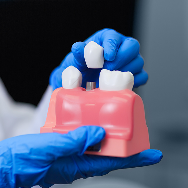 Implant dental crown model