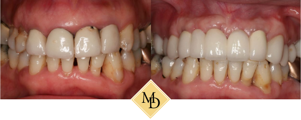 Before and after dental implants
