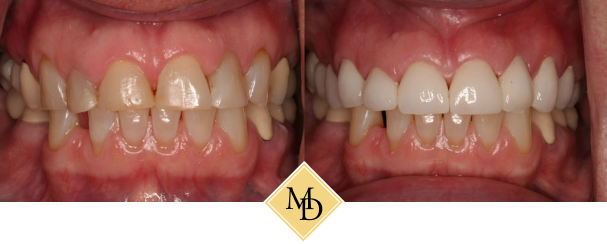 Before and after dental crowns