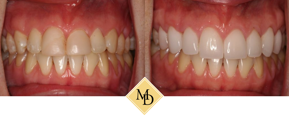Before and after gum lift and veneers