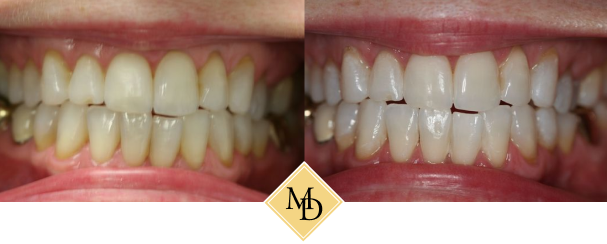 Before and after whitening