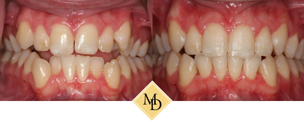 Before and after smile makeover