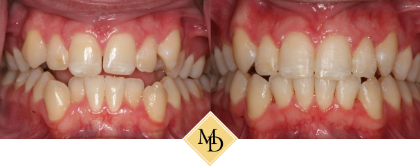 Before and after smile makeover