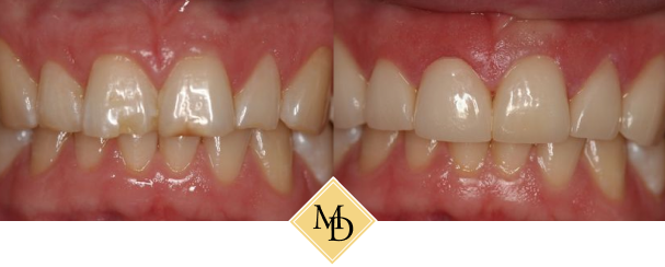 Before and after dental bonding