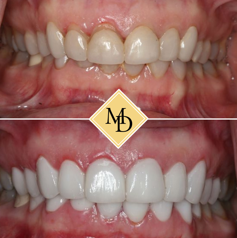 Before and after veneers