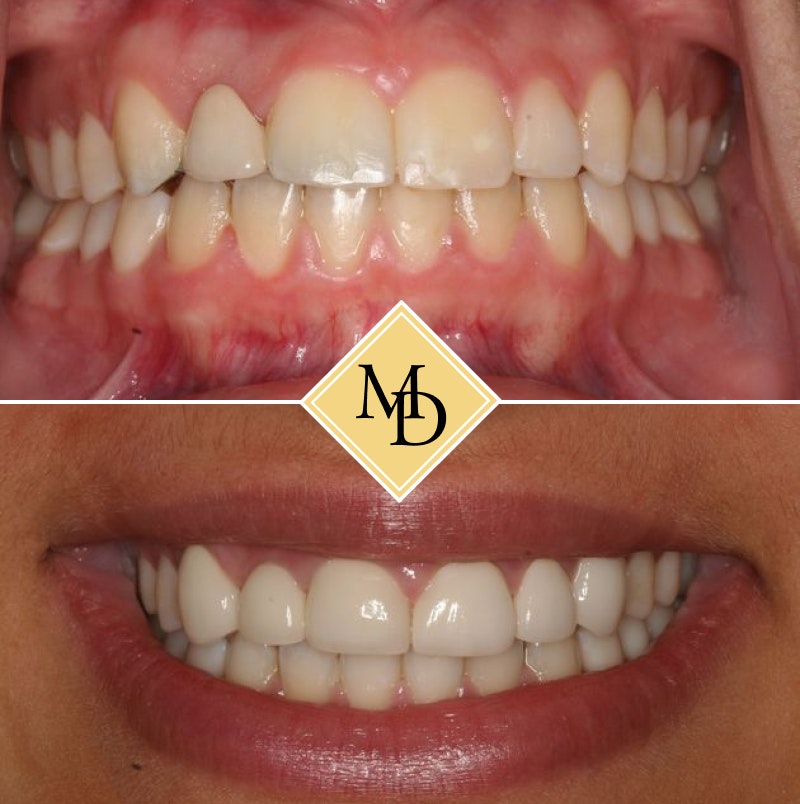 Before and after veneers