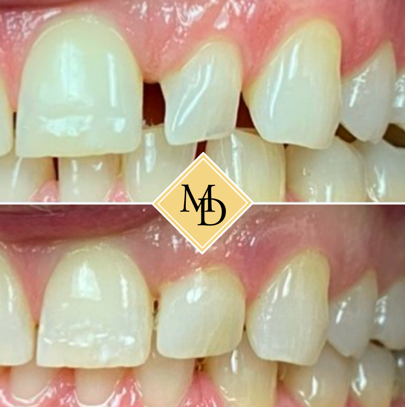 Before and after bonding