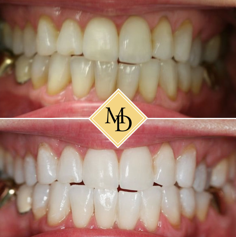 Before and after teeth whitening