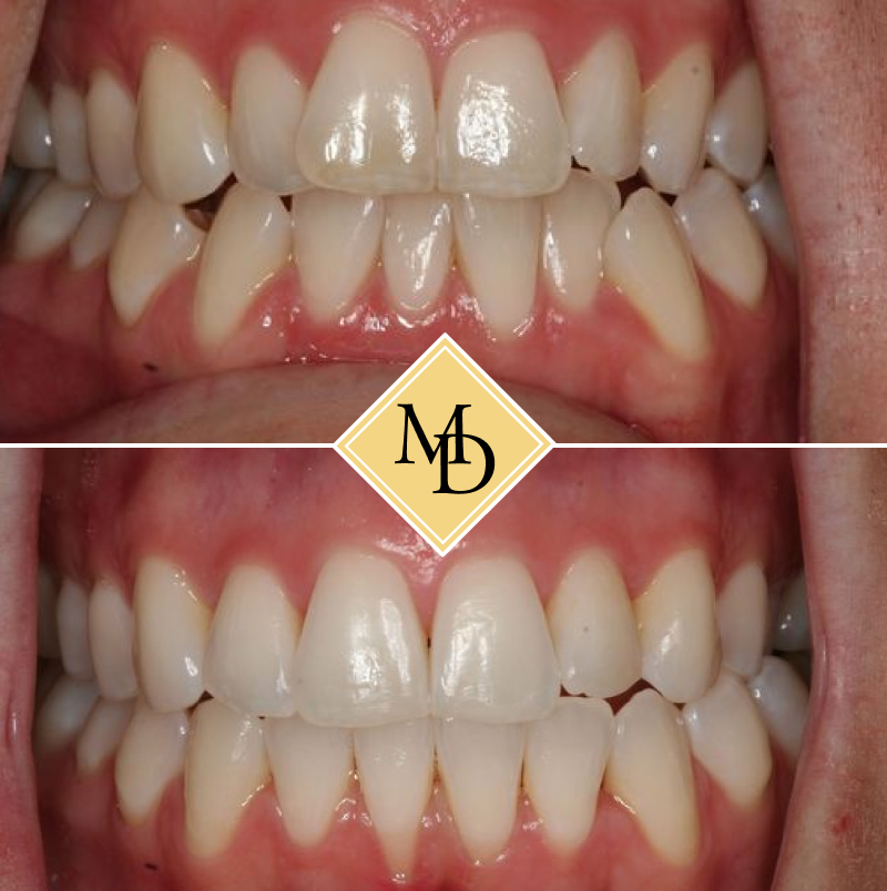 Before and after Invisalign