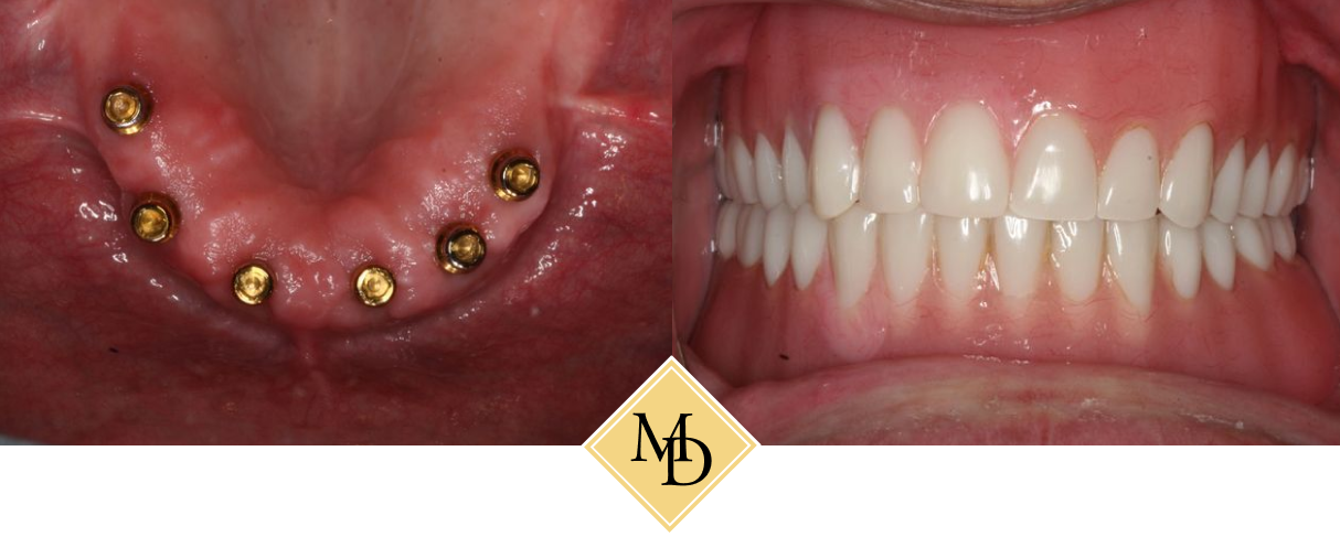 Traditional Dental Implants