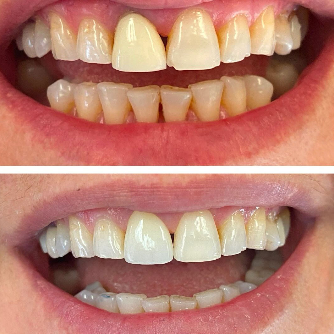 patient before and after crown