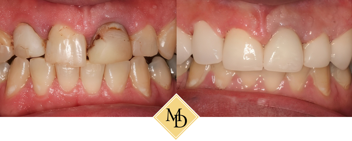patient before and after crowns