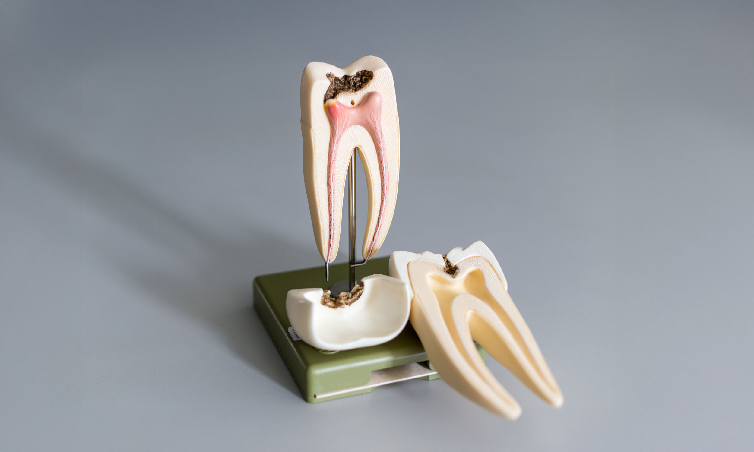 Model of a decayed tooth and its pulp chamber