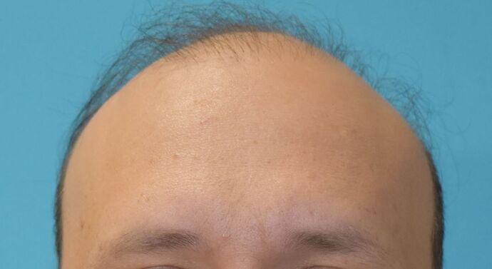 Before hair loss treatment