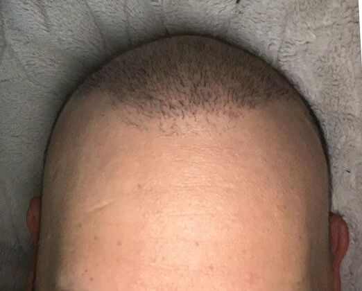 After hair loss treatment