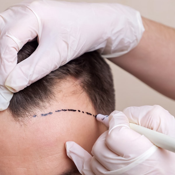 Doctor marking patients head