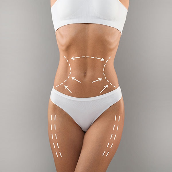 Sketch drawn over a woman's body to show commen areas addressed during a mommy makeover