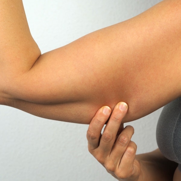 Person pinching their underarm to show what excess tissue they want removed
