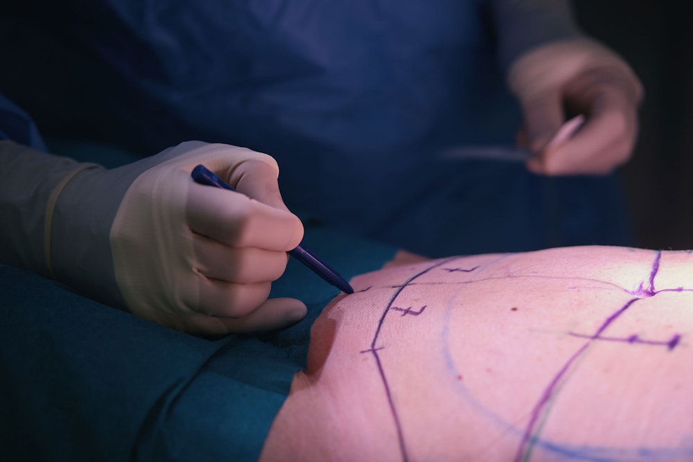 Tummy tuck incision markings