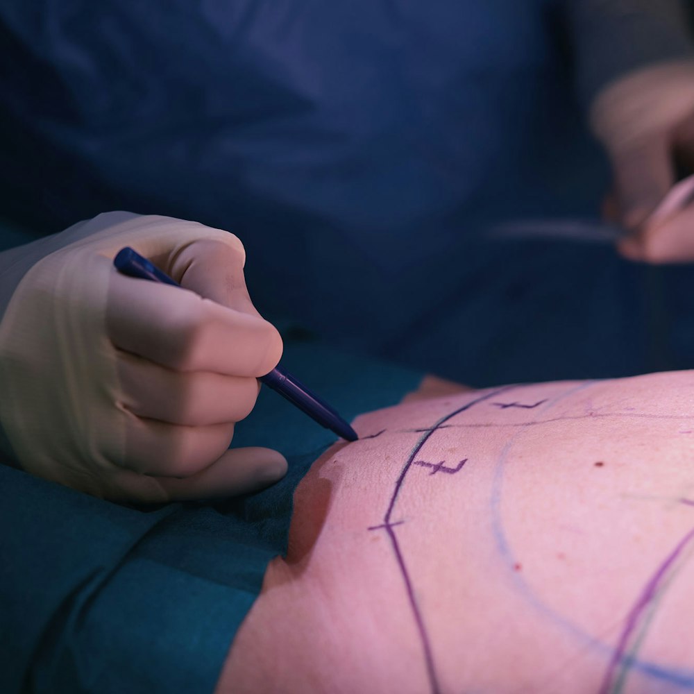 Tummy tuck incision markings