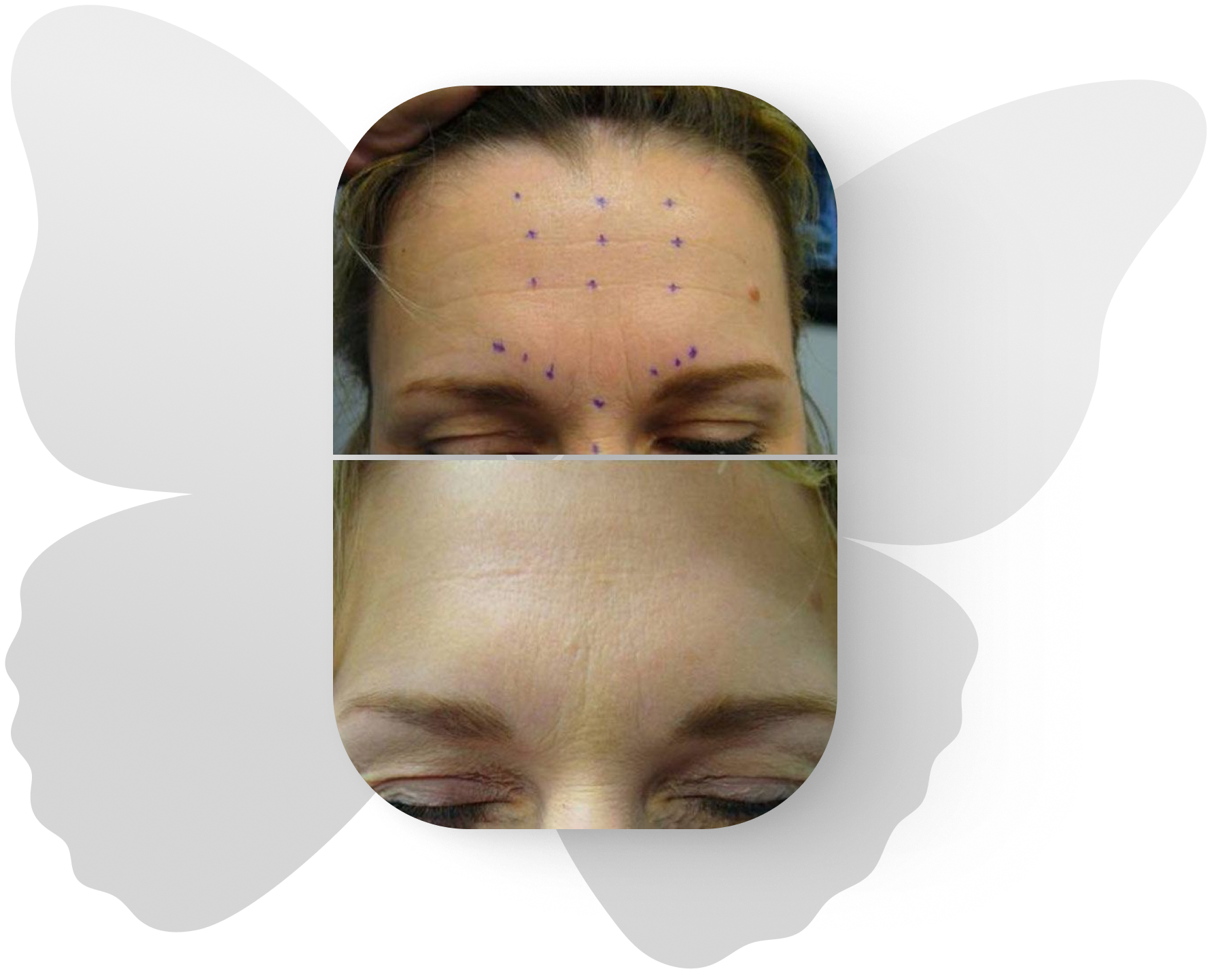 Before and after injectables