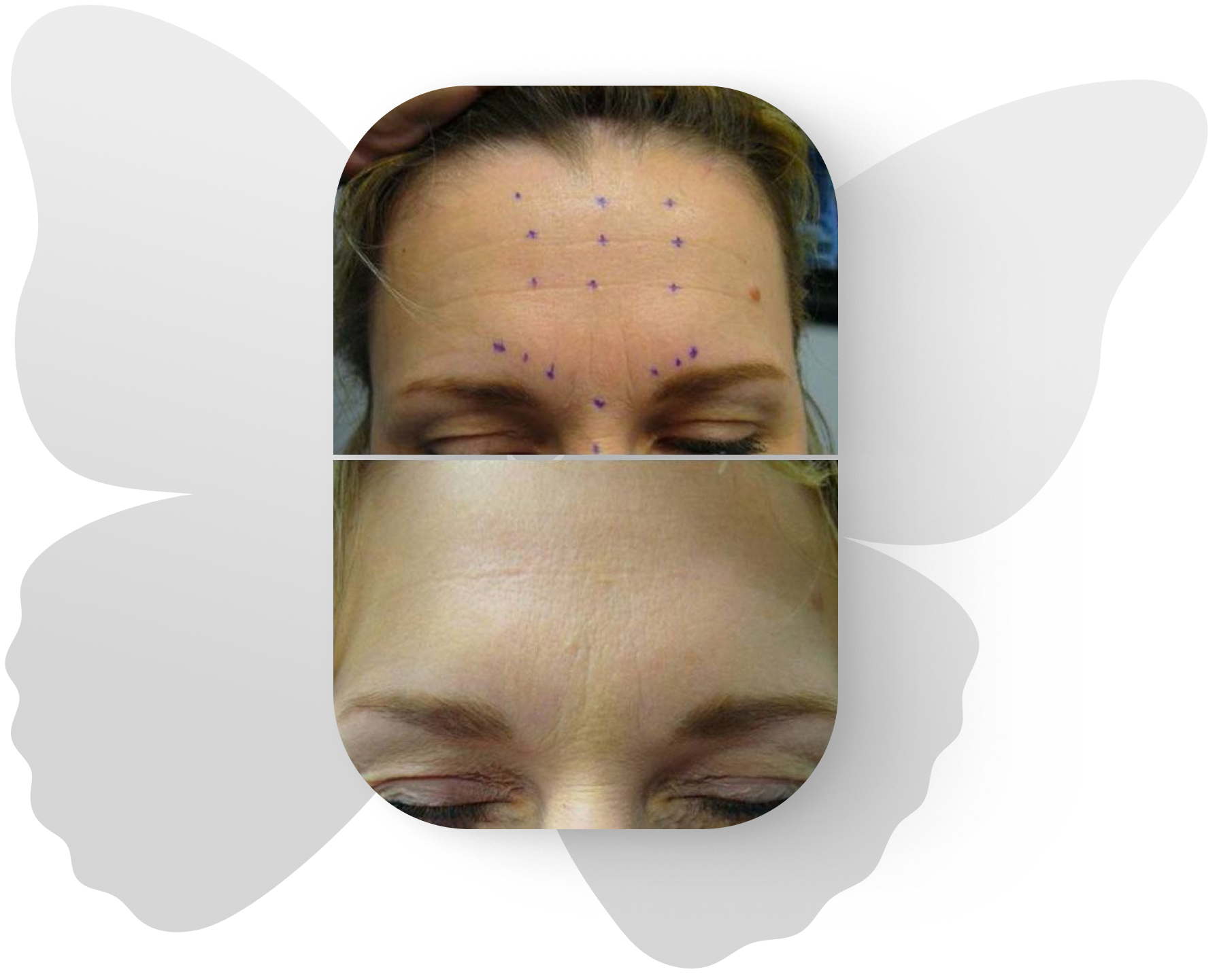 Before and after injectables