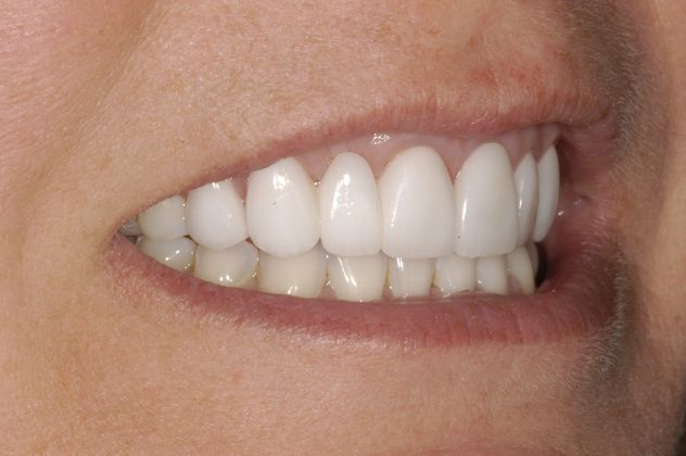 Dr. Edward Narcisi's patient after veneers