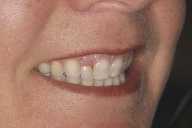 Dr. Edward Narcisi's patient before veneers