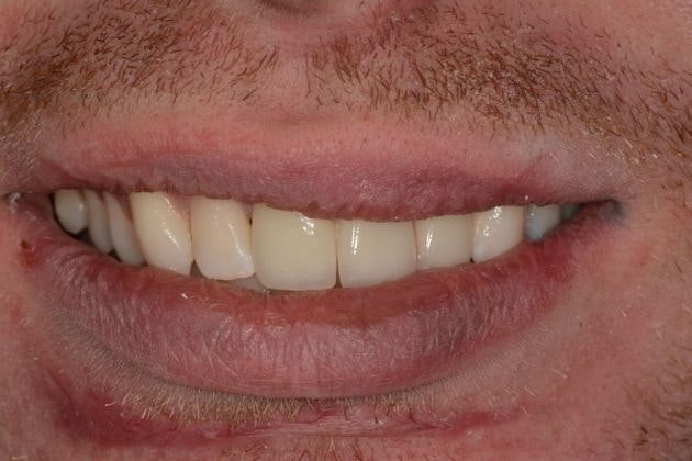 After Dental Implants