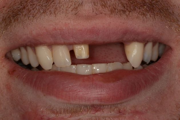 Before Dental Implants