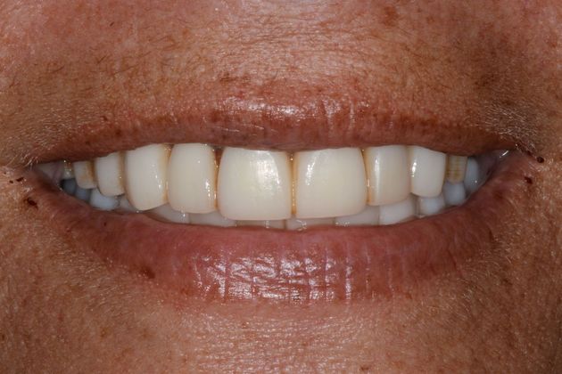 Before dental crowns