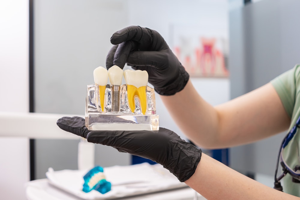 Dentist showing model of an implant-supported crown