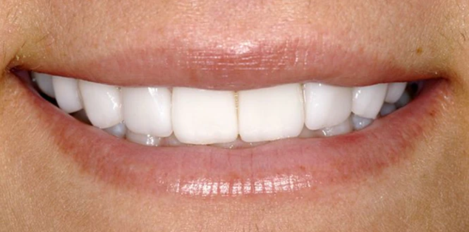 enhanced smile