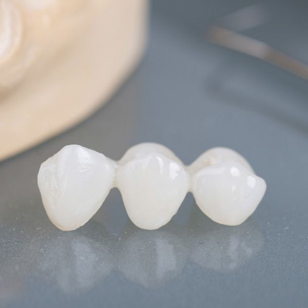 Closeup of dental bridge