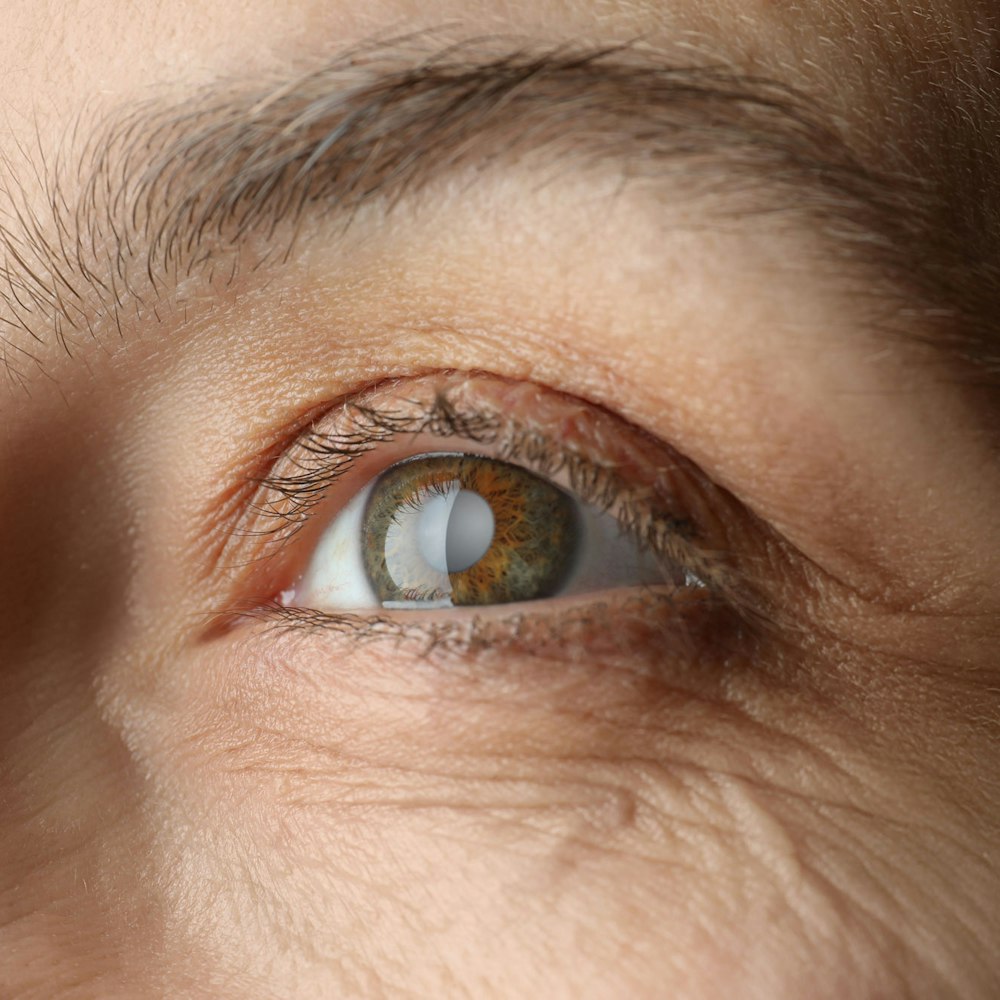 Patient with cataracts