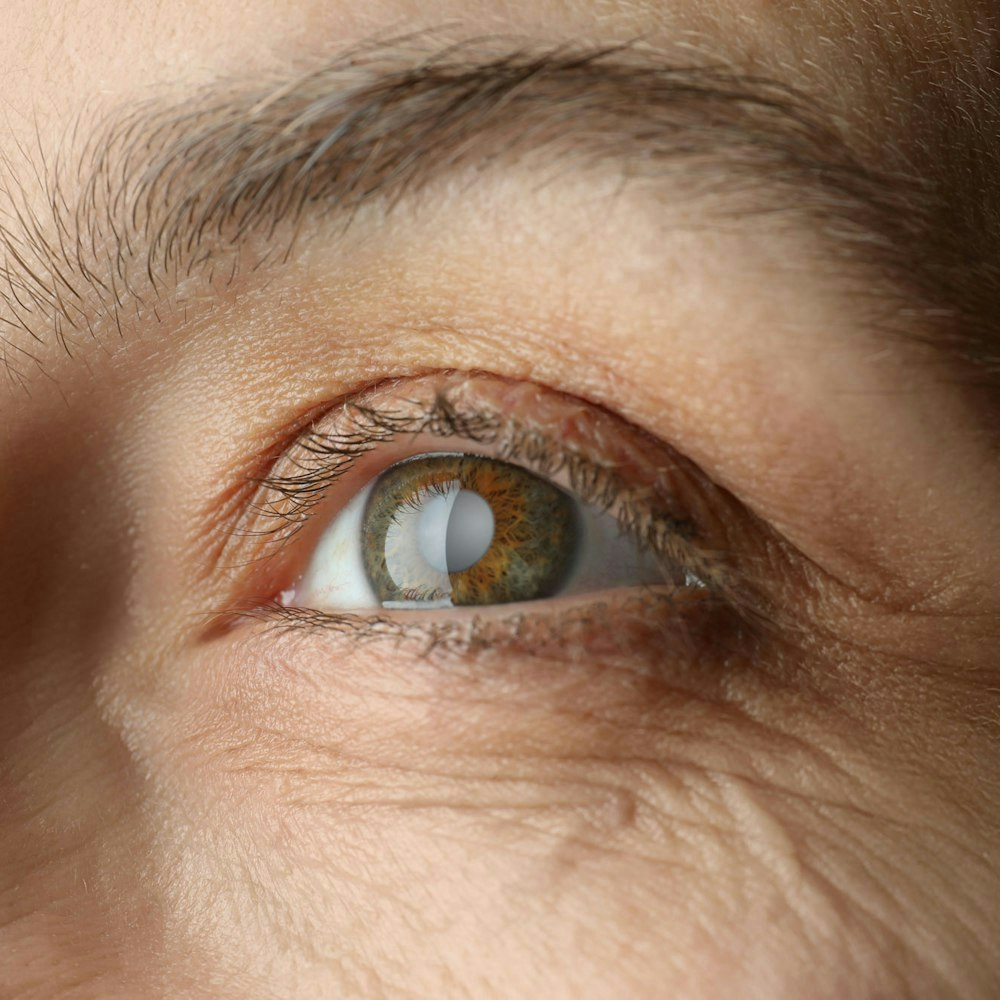 Patient with cataracts