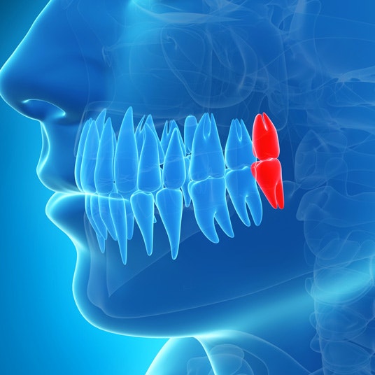 A 3D render showing wisdom teeth location with X-ray vision