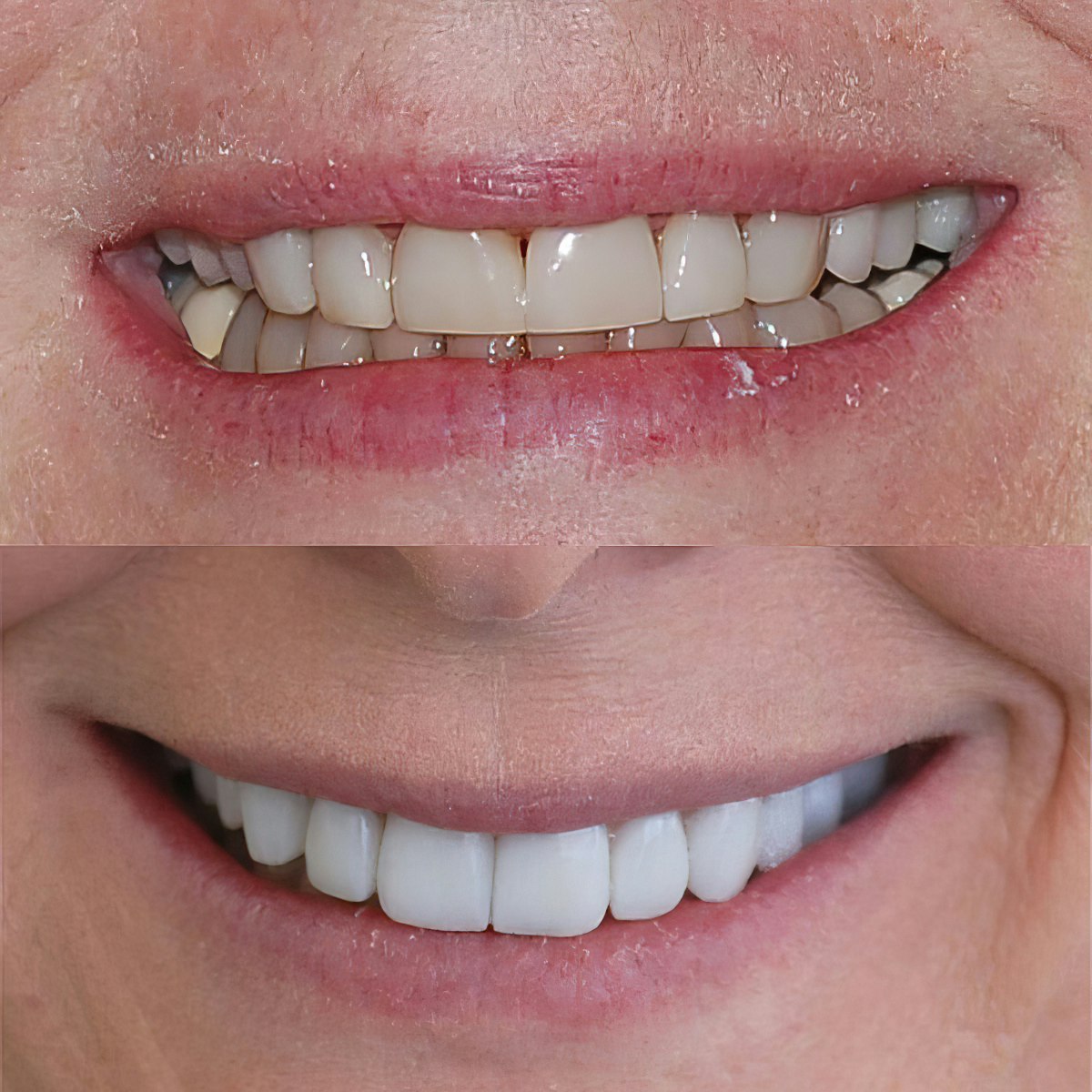 before and after porcelain veneers images